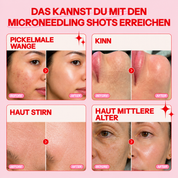 Bio-Microneedling | Needless Shot Soft (+ gratis Milky Toner!)