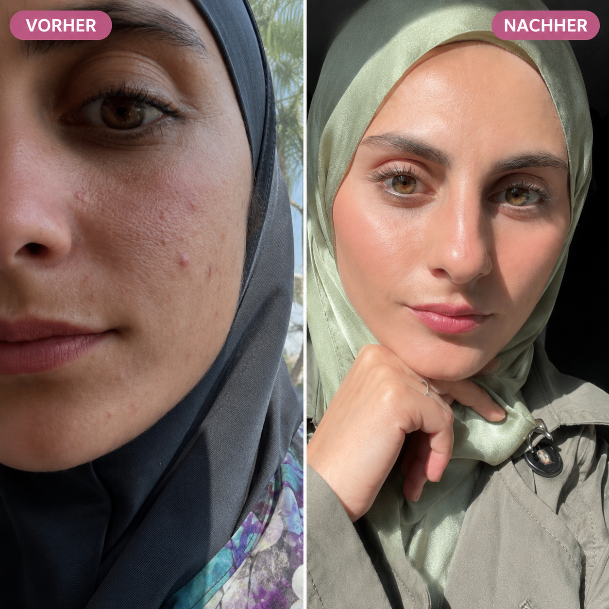 Bio-Microneedling | Needless Shot Soft (+ gratis Milky Toner!)