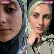 Bio-Microneedling | Needless Shot Soft (+ gratis Milky Toner!)