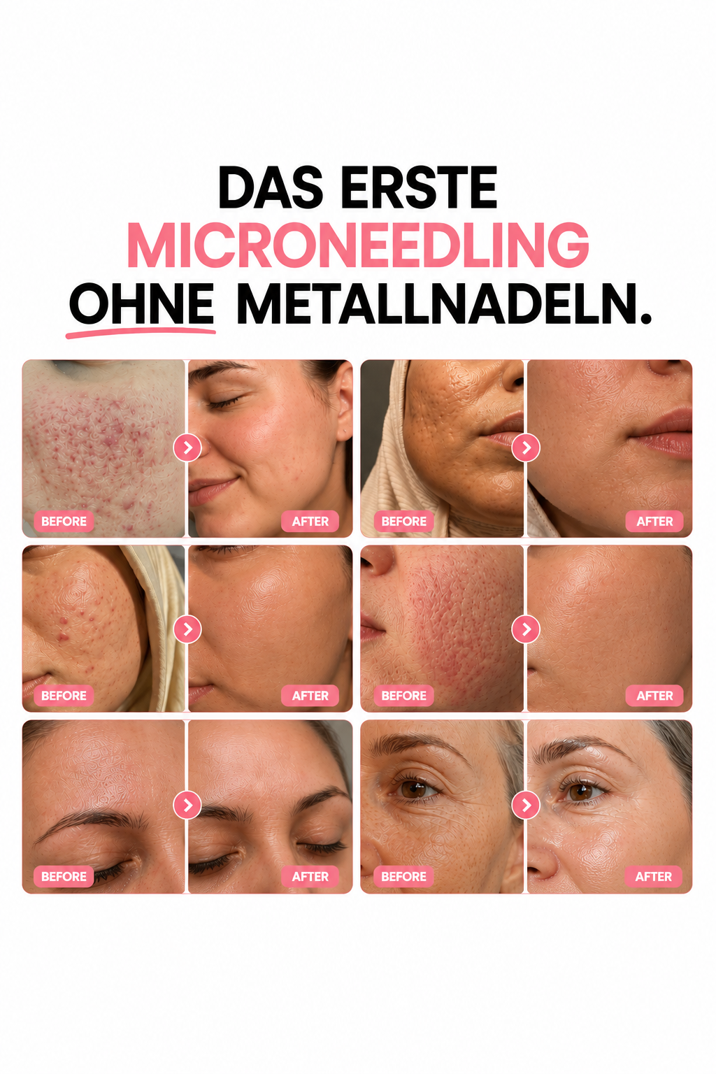 Bio-Microneedling | Needless Shot Soft (+ gratis Milky Toner!)