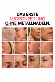 Bio-Microneedling | Needless Shot Soft (+ gratis Milky Toner!)