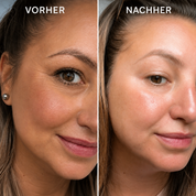 Bio-Microneedling | Needless Shot Soft (+ gratis Milky Toner!)