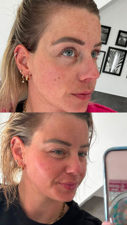 Bio-Microneedling | Needless Shot Soft (+ gratis Milky Toner!)