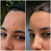 Bio-Microneedling | Needless Shot Soft (+ gratis Milky Toner!)
